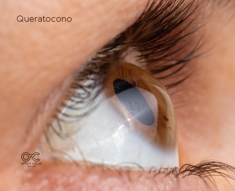 lentes de contacto en Valencia - queratocono